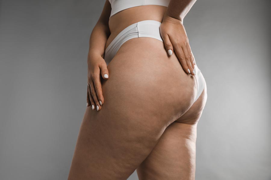 cellulite