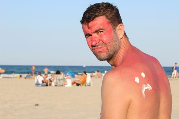 consigli bruciatura da sole consigli bruciatura da sole