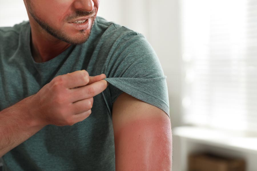 cosa mettere su bruciatura da sole cosa mettere su bruciatura da sole