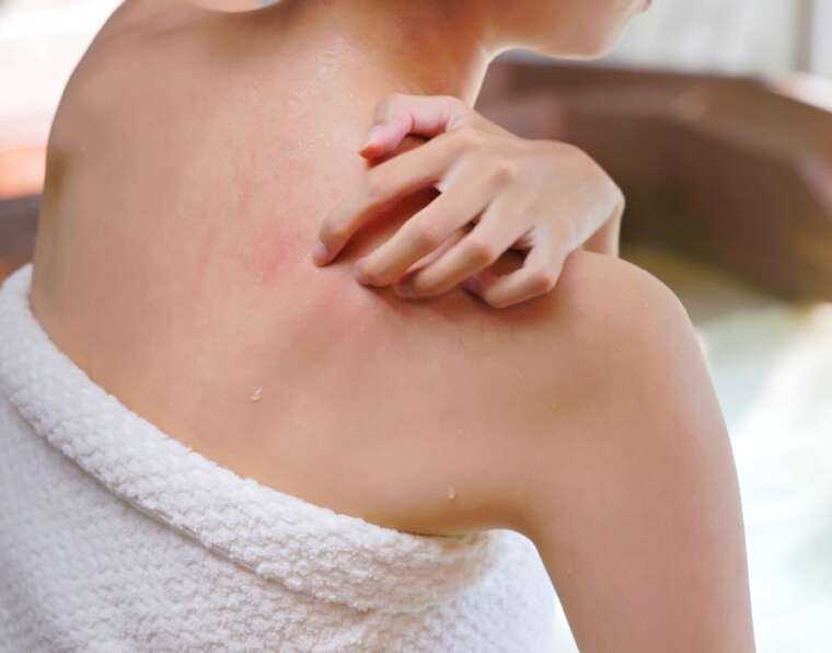 pelle che prude dopo doccia