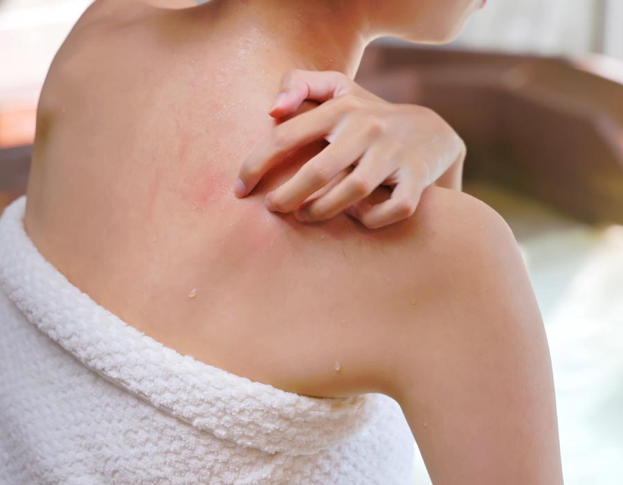 pelle che prude dopo doccia